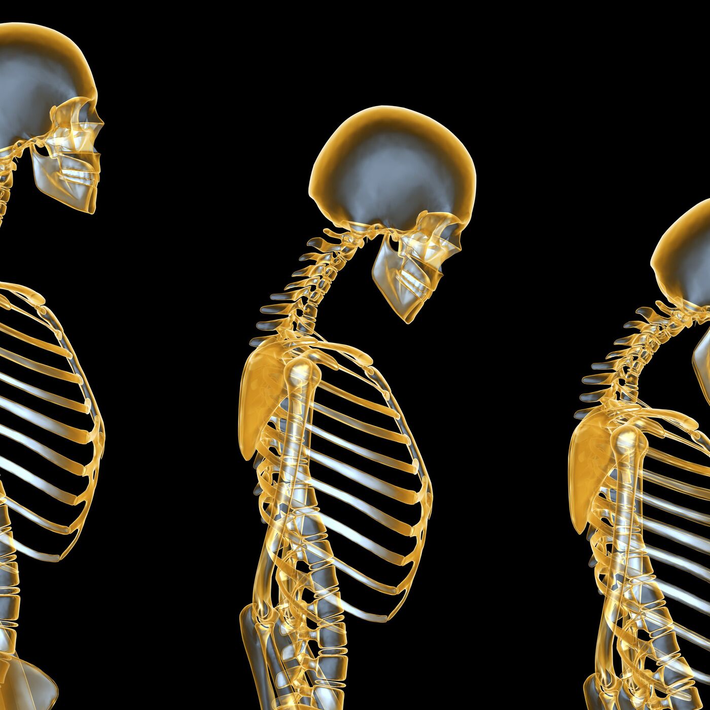 Overview of Osteoporosis-: a guide for patients