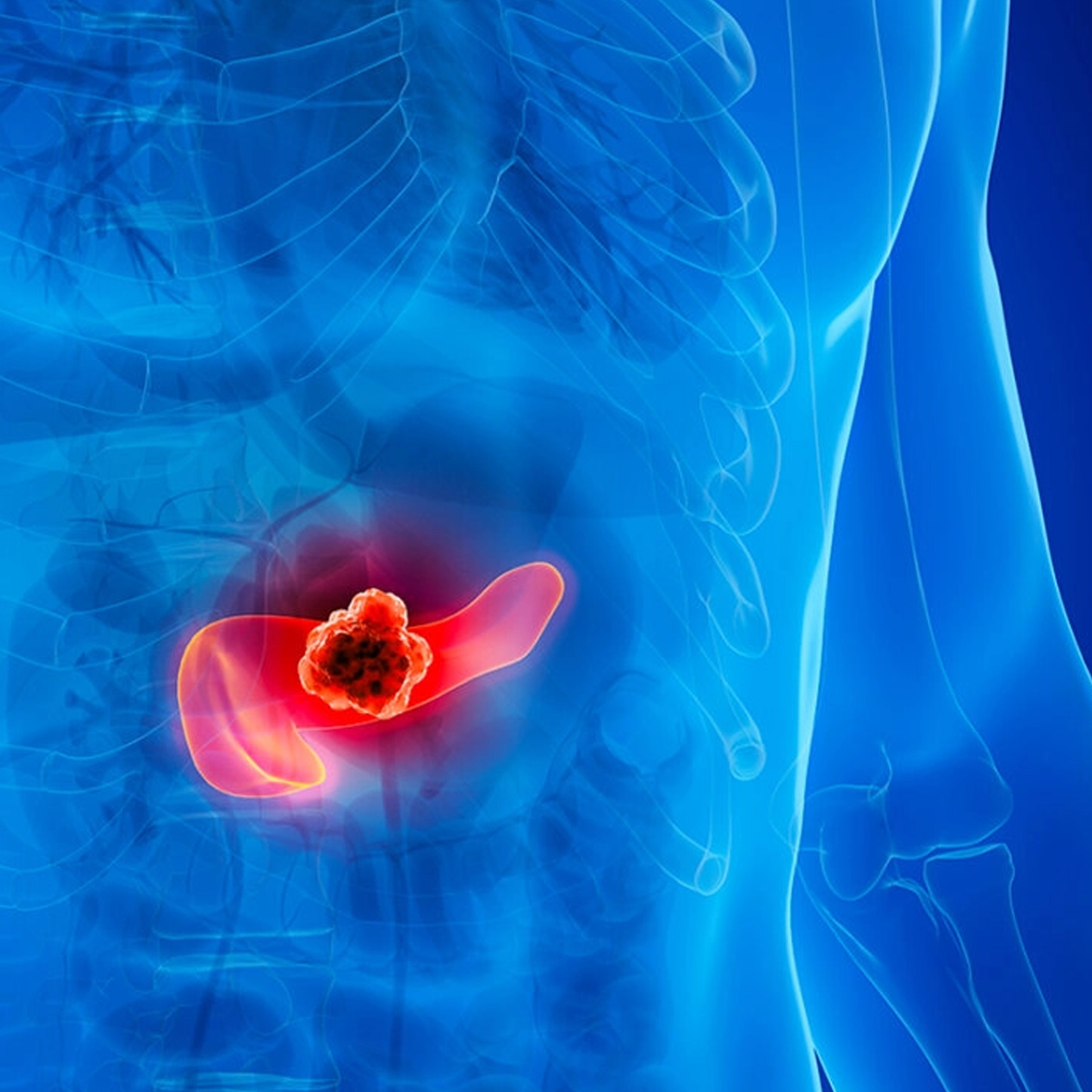 Insulin Resistance is Silent Driver of Pancreatic Cancer